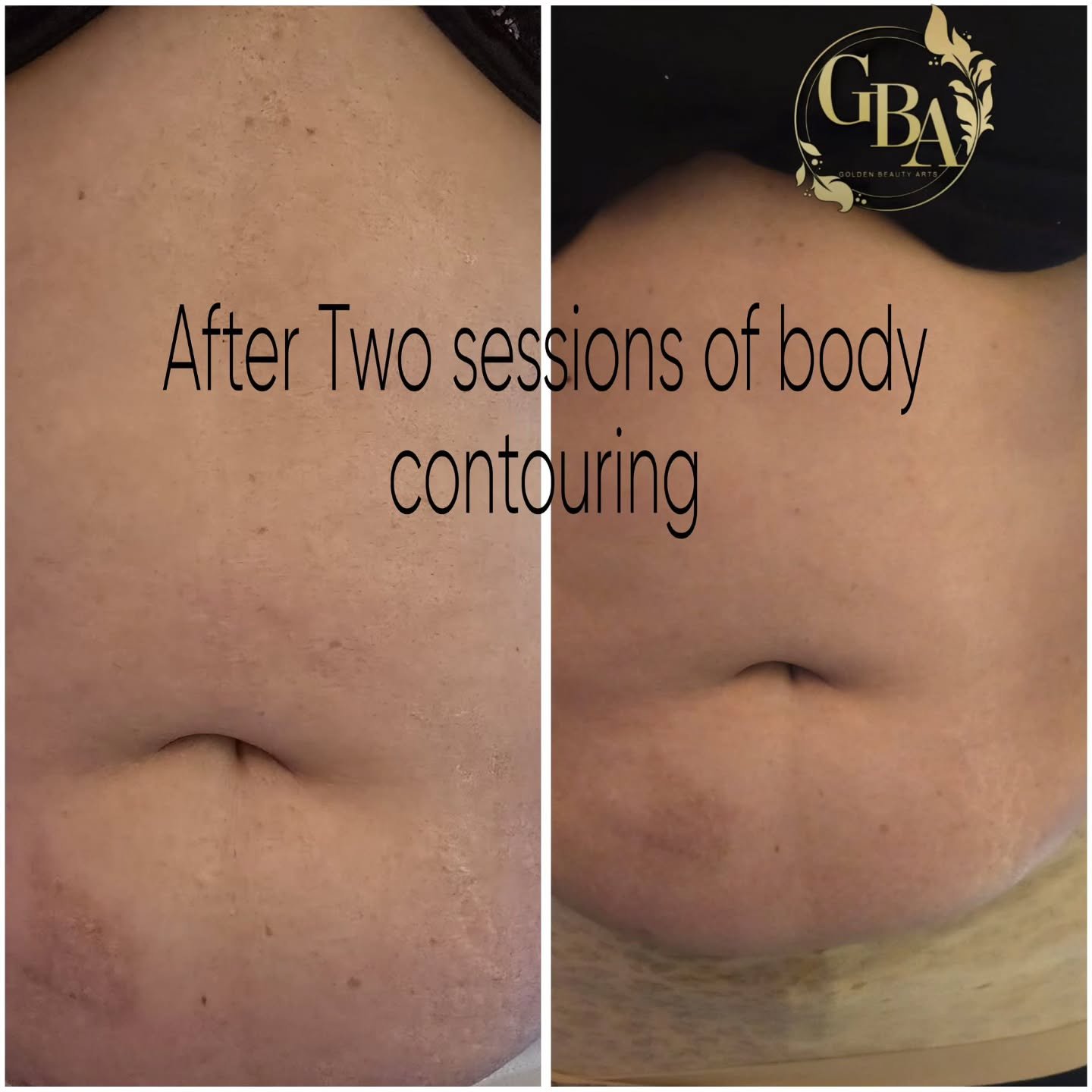 Body contouring treatment room at Golden Beauty Arts in Mississauga