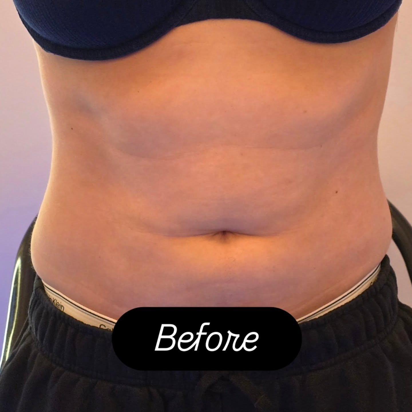 Lipo laser body contouring treatment at Golden Beauty Arts in Mississauga