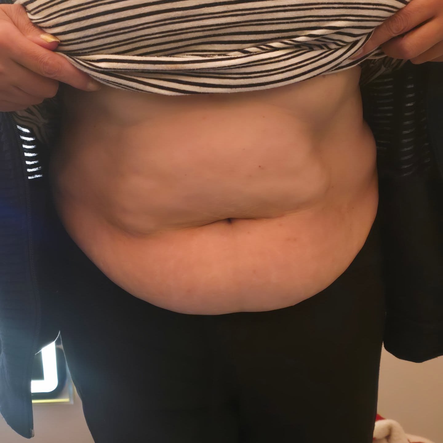Body contouring treatment at Golden Beauty Arts in Mississauga