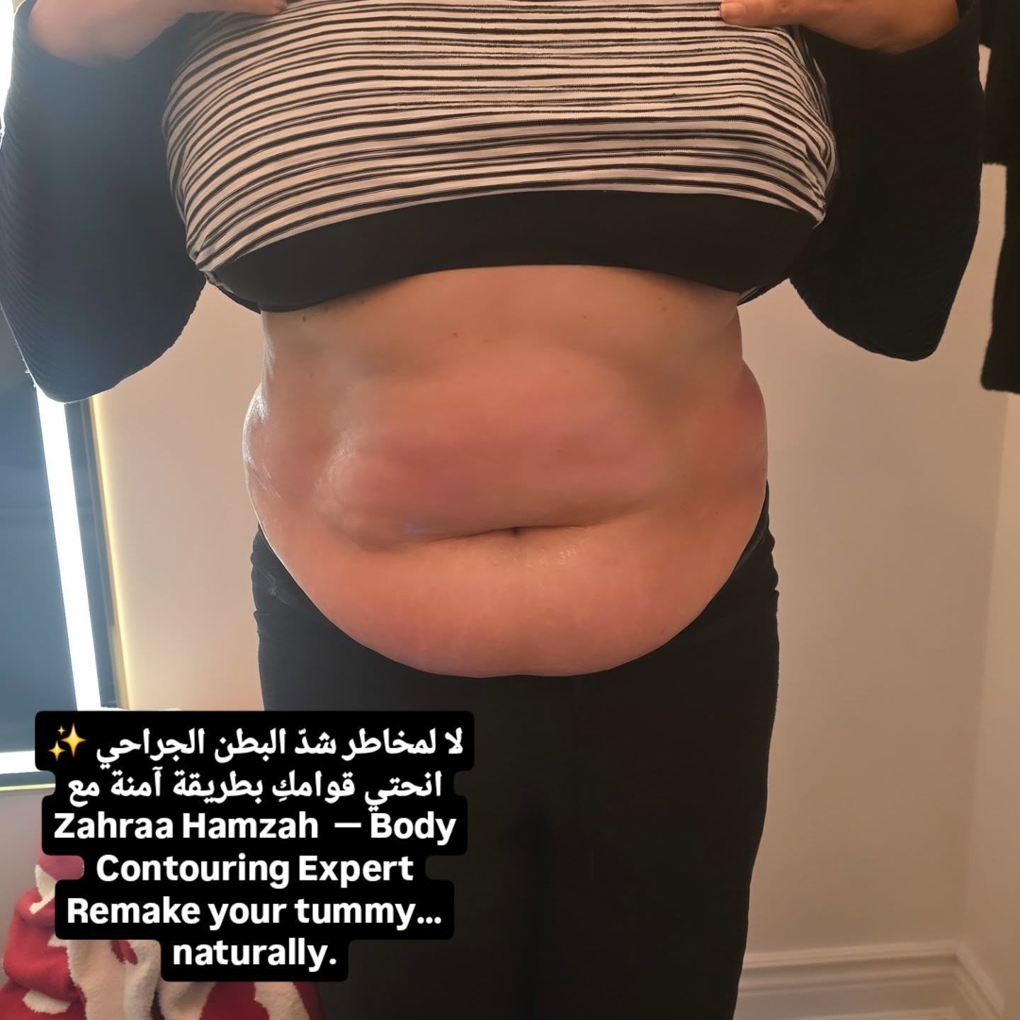 80K cavitation body contouring at Golden Beauty Arts in Mississauga