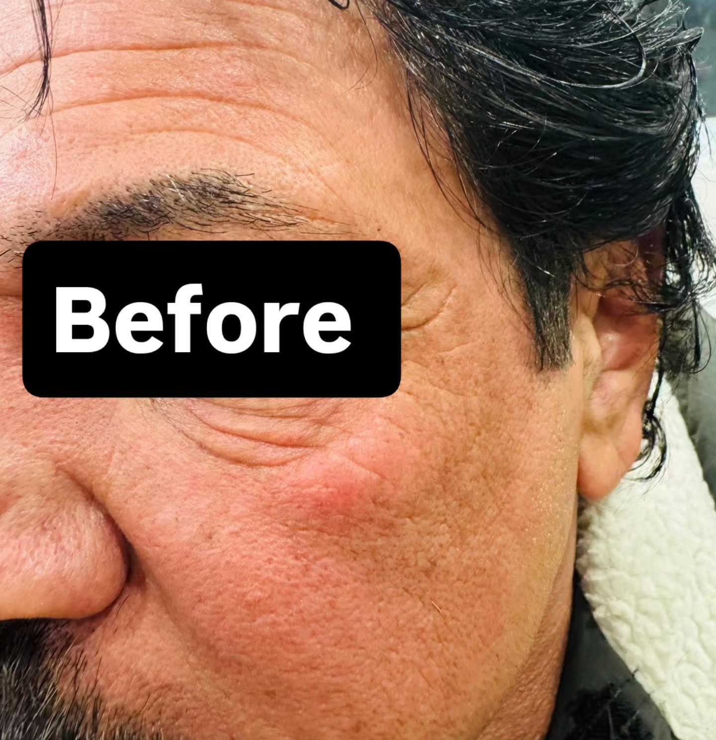 SQT microneedling treatment room at Golden Beauty Arts in Mississauga