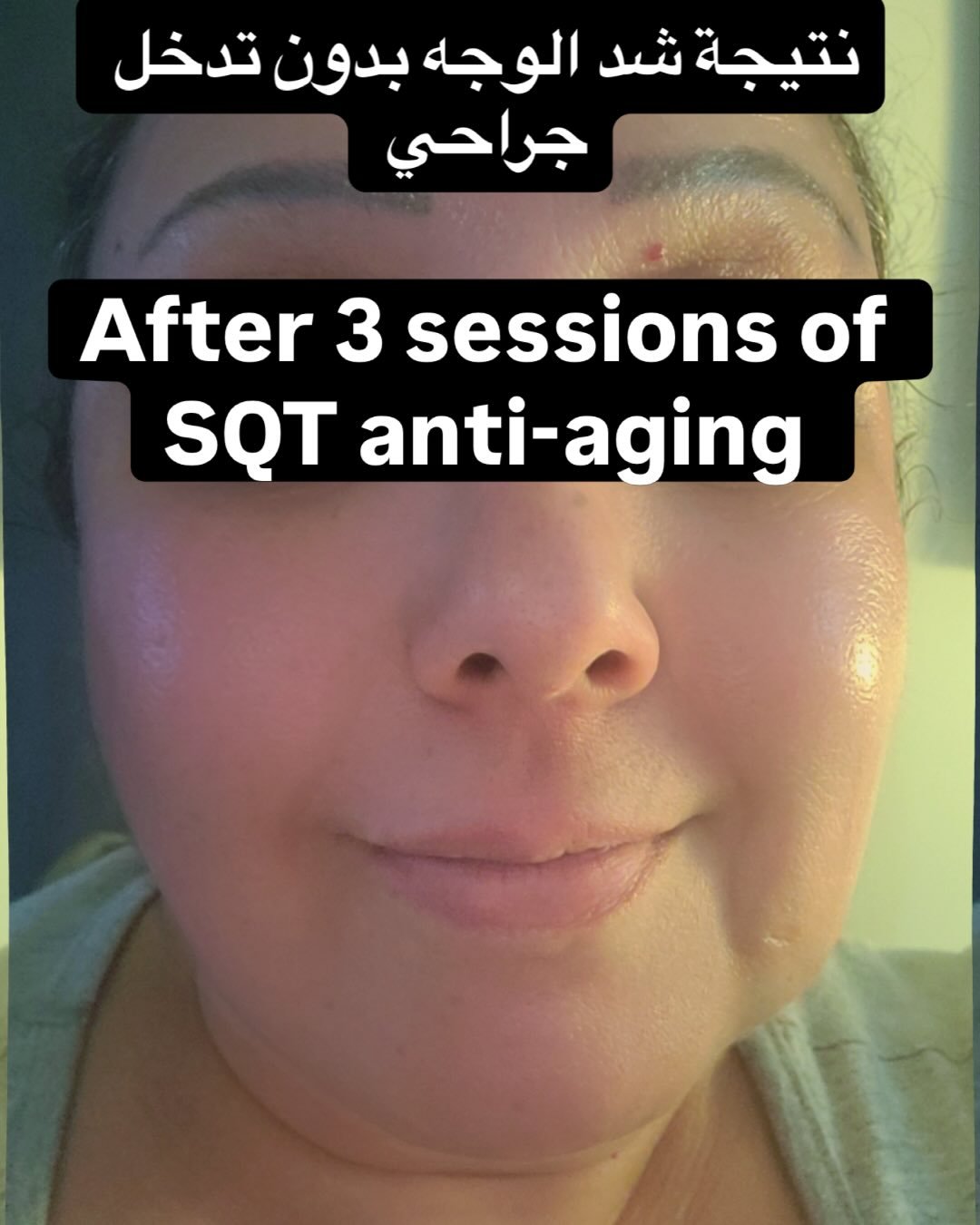 SQT treatment session at Golden Beauty Arts in Mississauga