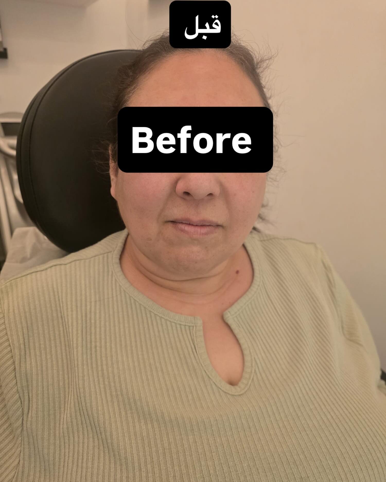 SQT bio-microneedling treatment at Golden Beauty Arts in Mississauga