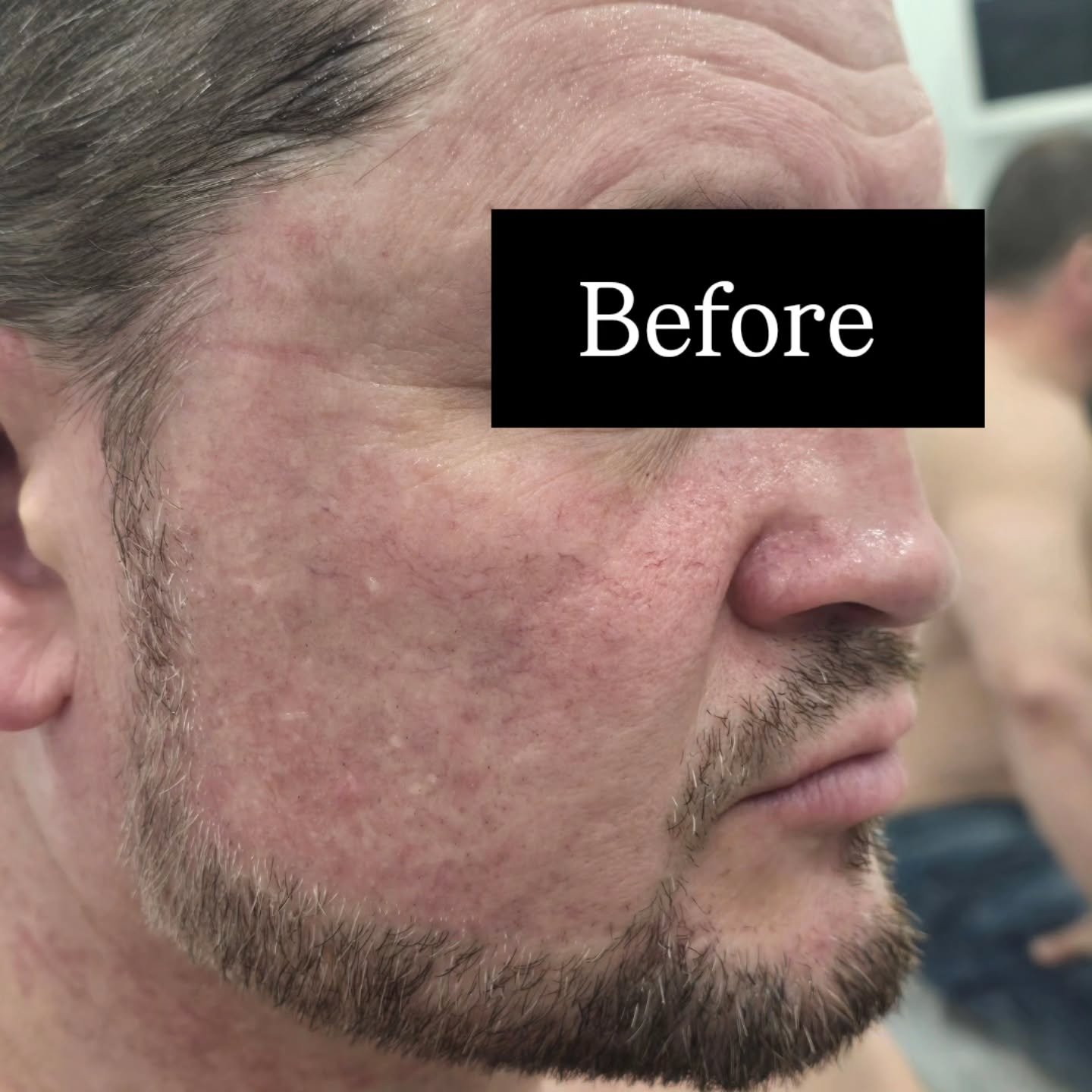IPL skin rejuvenation treatment at Golden Beauty Arts in Mississauga