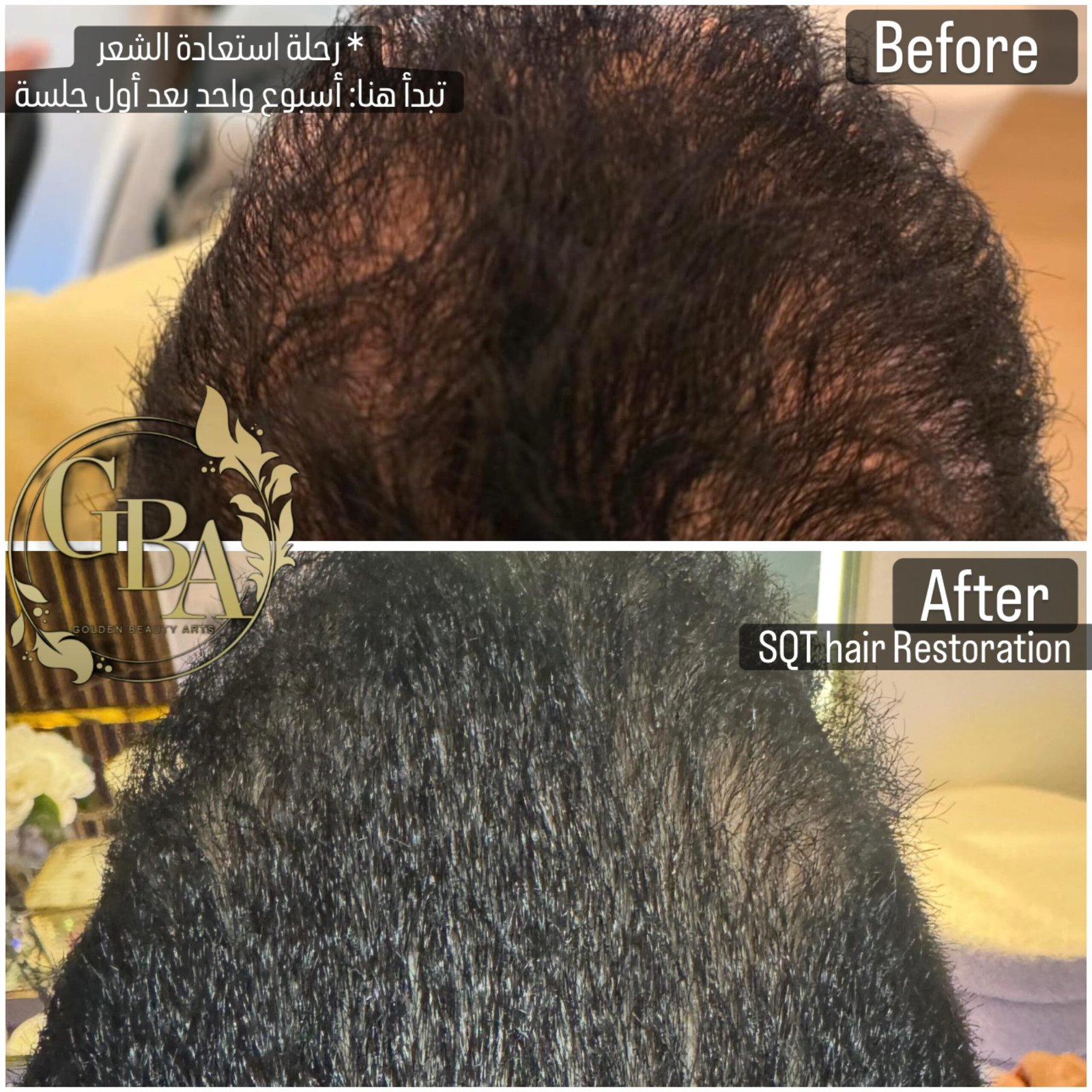 SQT bio-microneedling skincare at Golden Beauty Arts in Mississauga